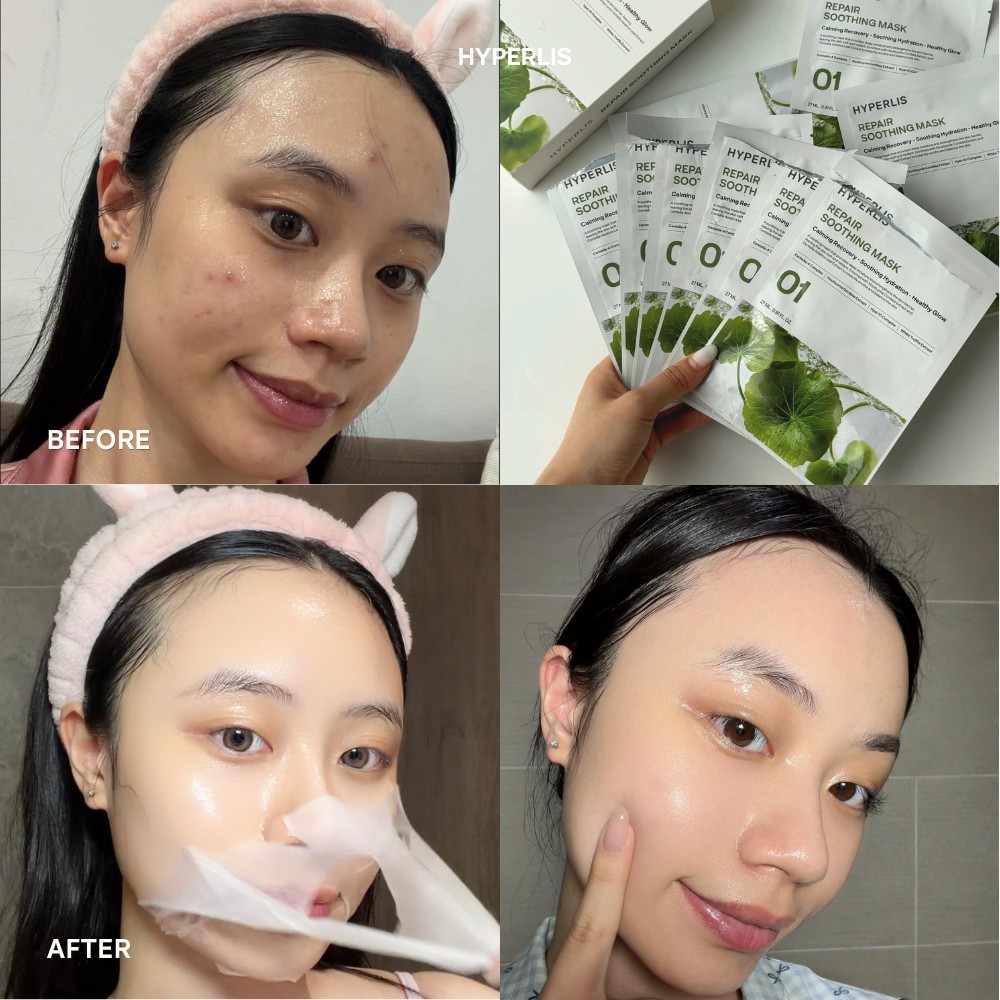 Trước sau dùng mặt nạ HYPERLIS 1