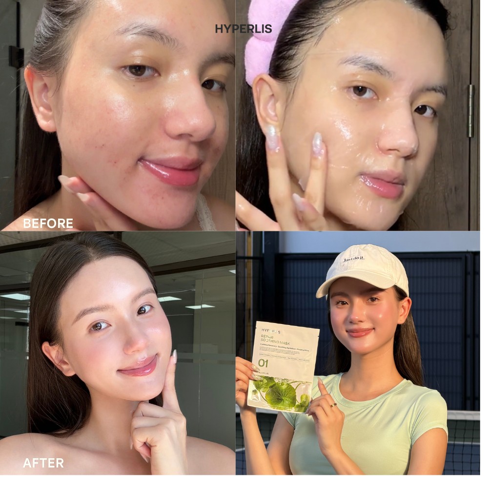 Trước sau dùng mặt nạ HYPERLIS 2
